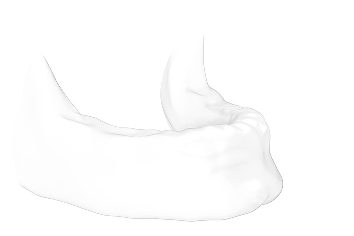 All-on-4® Feste Zähne auf 4 Implantaten: Modell Kiefer / Planung