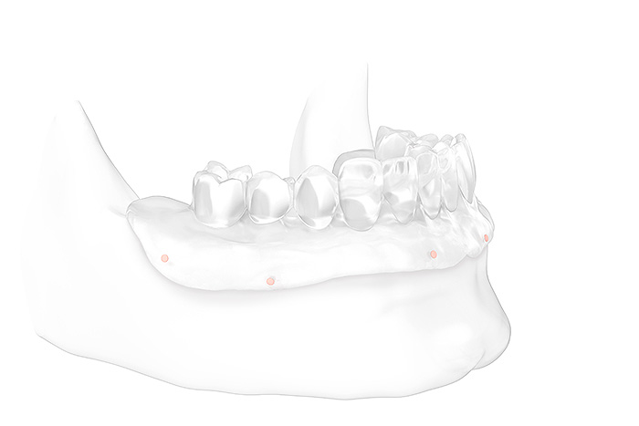 All-on-4® Feste Zähne auf 4 Implantaten: Modell Kiefer