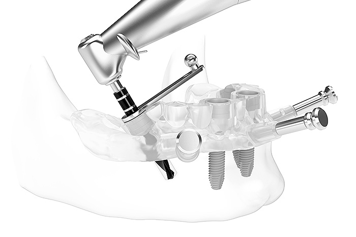 All-on-4® Feste Zähne auf 4 Implantaten Abutments fest verschrauben