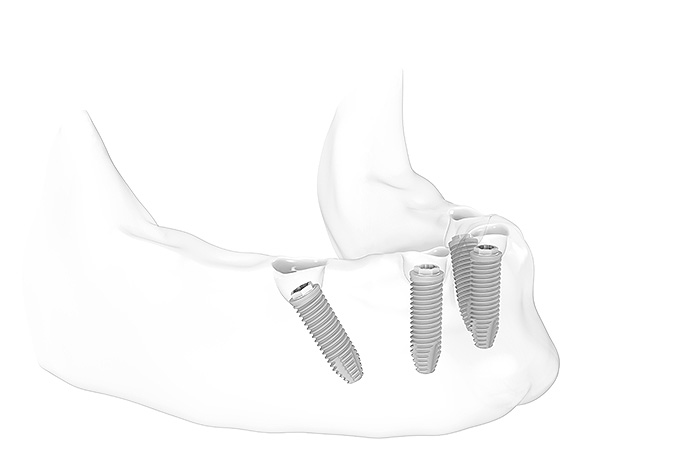 All-on-4® für Feste Zähne - Implantate einsetzen