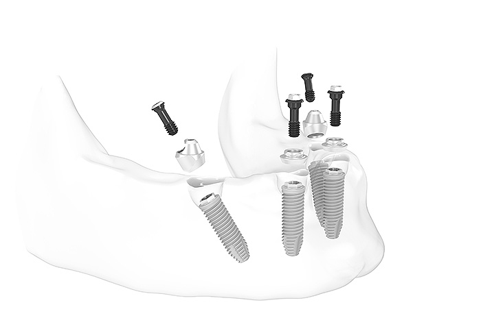 All-on-4® Feste Zähne auf 4 Implantaten Behandlungsschritt