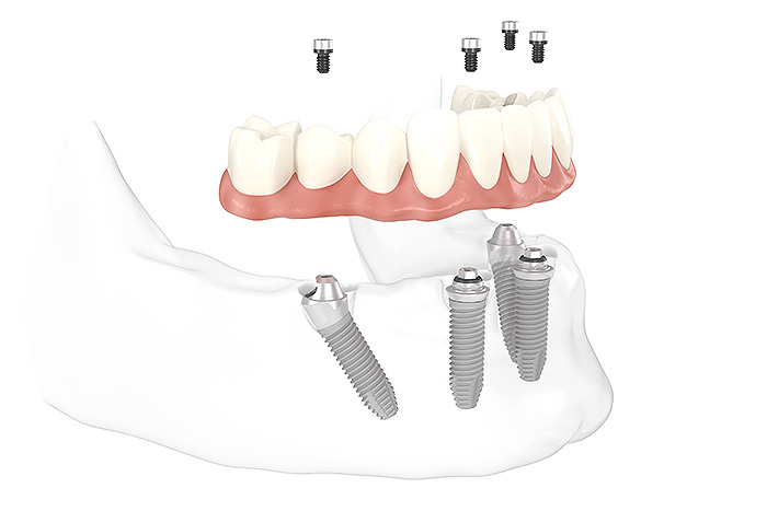 All-on-4® Feste Zähne auf 4 Implantaten